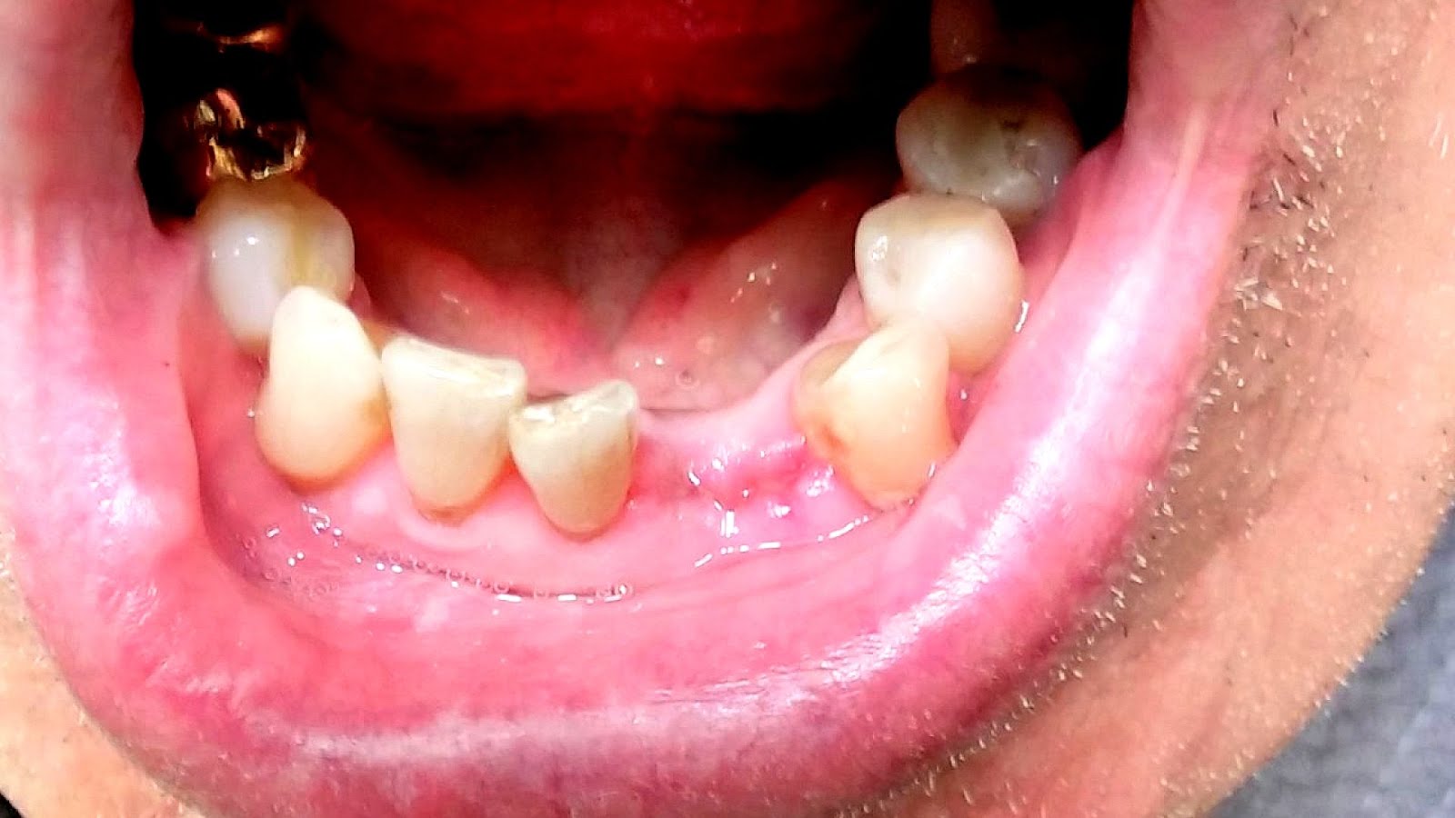 What Causes Dry Socket After Tooth Extraction Sock Choices