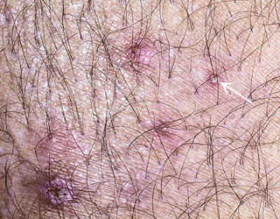 Bacterial folliculitis, showing hairs emerging from pustules (arrow). Bacterial folliculitis, showing hairs emerging from pustules (arrow).