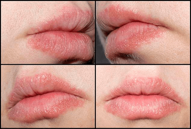 4 Cara mengatasi Alergi pada Bibir yang disebabkan oleh Lipstik 