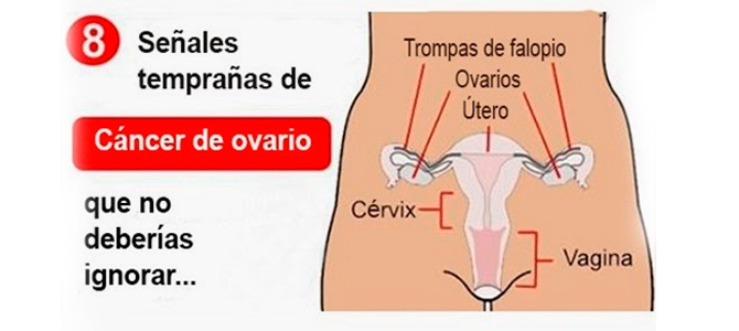 Cáncer de ovarios esperanza de vida