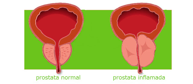 Inflamación prostática. dprostata