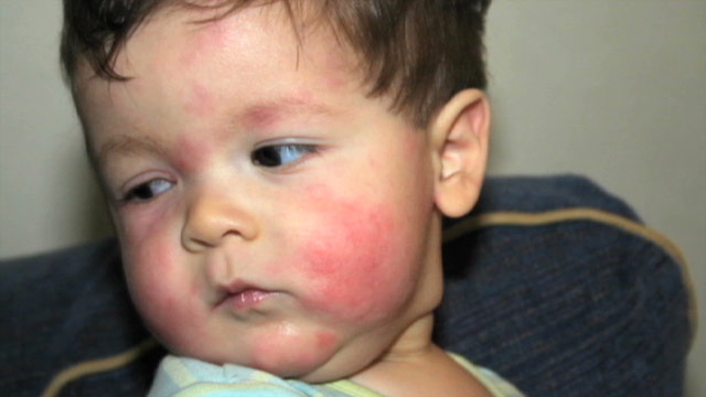 Rashes on Stomach & Back of a Toddler - Allergy - MedHelp