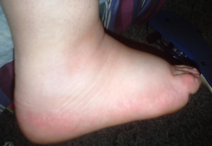 ayak sismesi nasil gecer