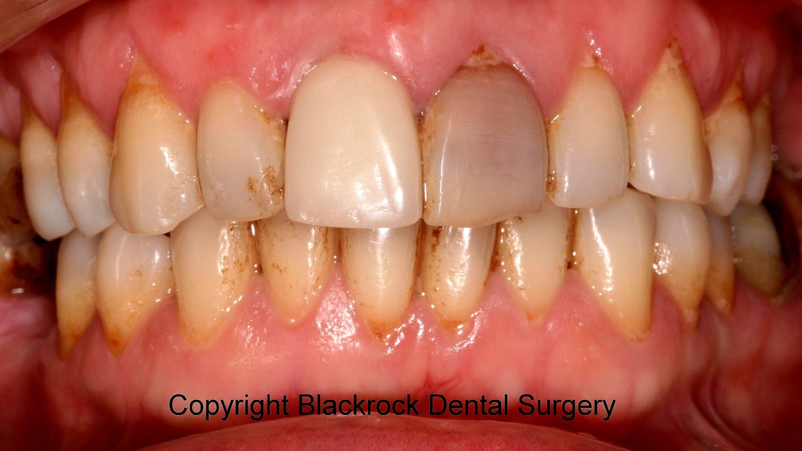 How To Whiten A Dead Tooth White Choices