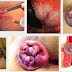 pengobatan ambeien di cilacap thumbnail