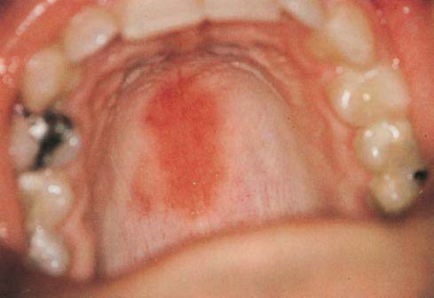 Pictures Of Red Spots On Palate 69