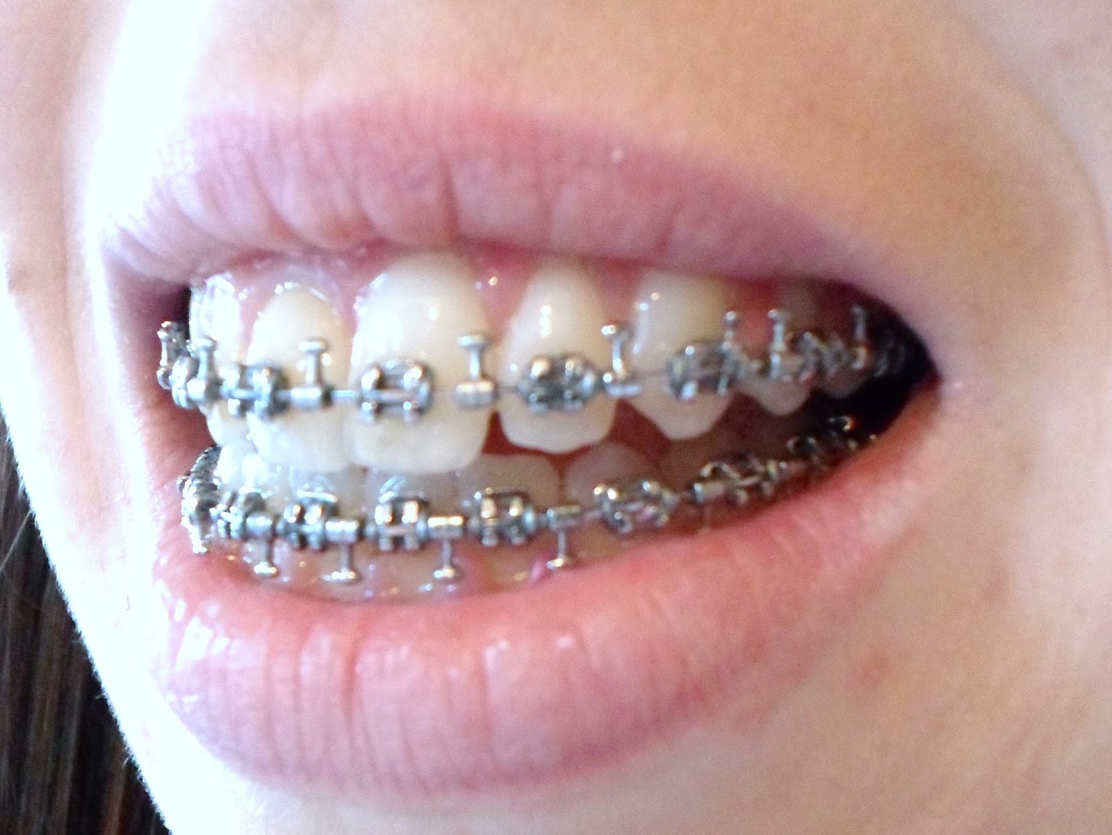 My jaw surgery and I.. Surgical Hooks On!