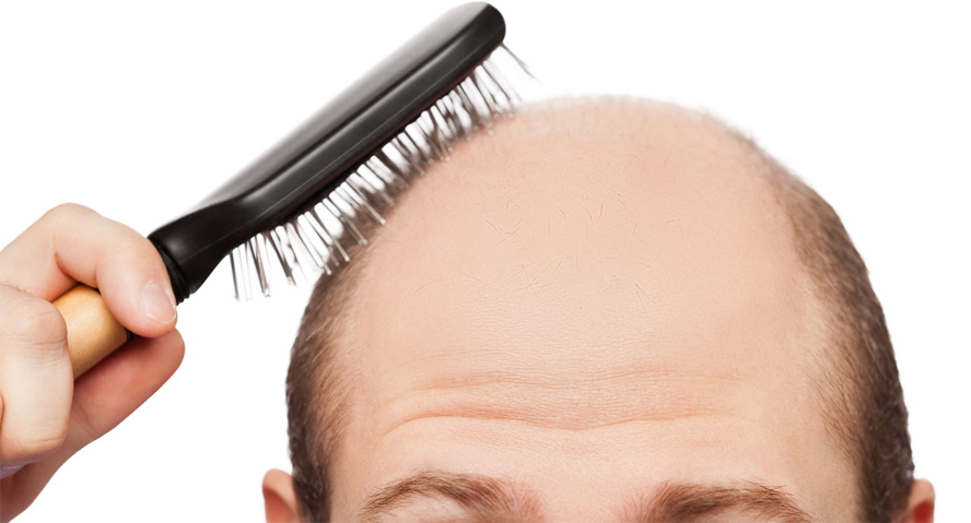 Top Home Herbal Remedies For Baldness 2get Healthcare