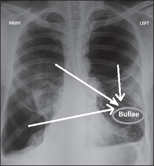 Буллы в легких что это такое. Буллезная болезнь легких рентген. Буллезная эмфизема рентген.
