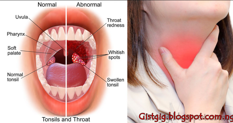 Home Made Natural Fast Remedy For Sore Throat Or Tonsillitis