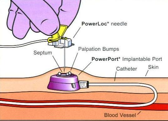 jm's Adventure with Multiple Myeloma: Intravenous Access Port - Bard ...