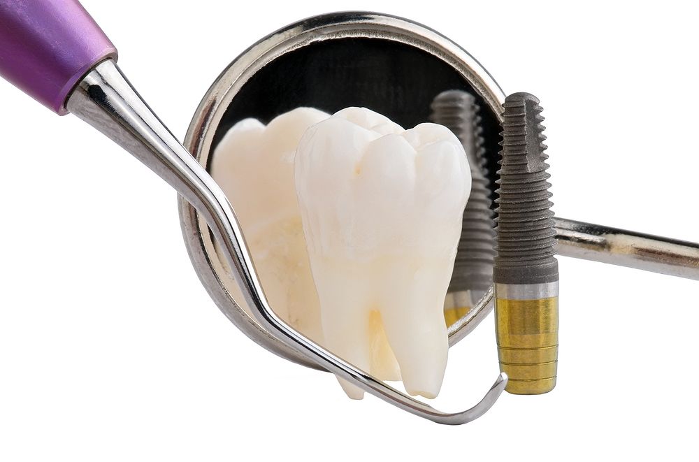 Maintenance of dental implants Part 2 Directorio Odontológico