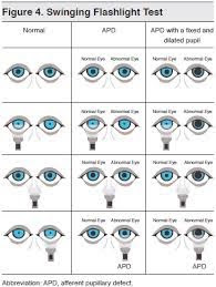 constricted pupil size meaning constricted pupil size meaning