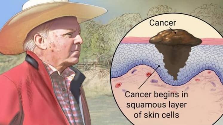 Squamous Cell Skin Carcinoma Symptoms