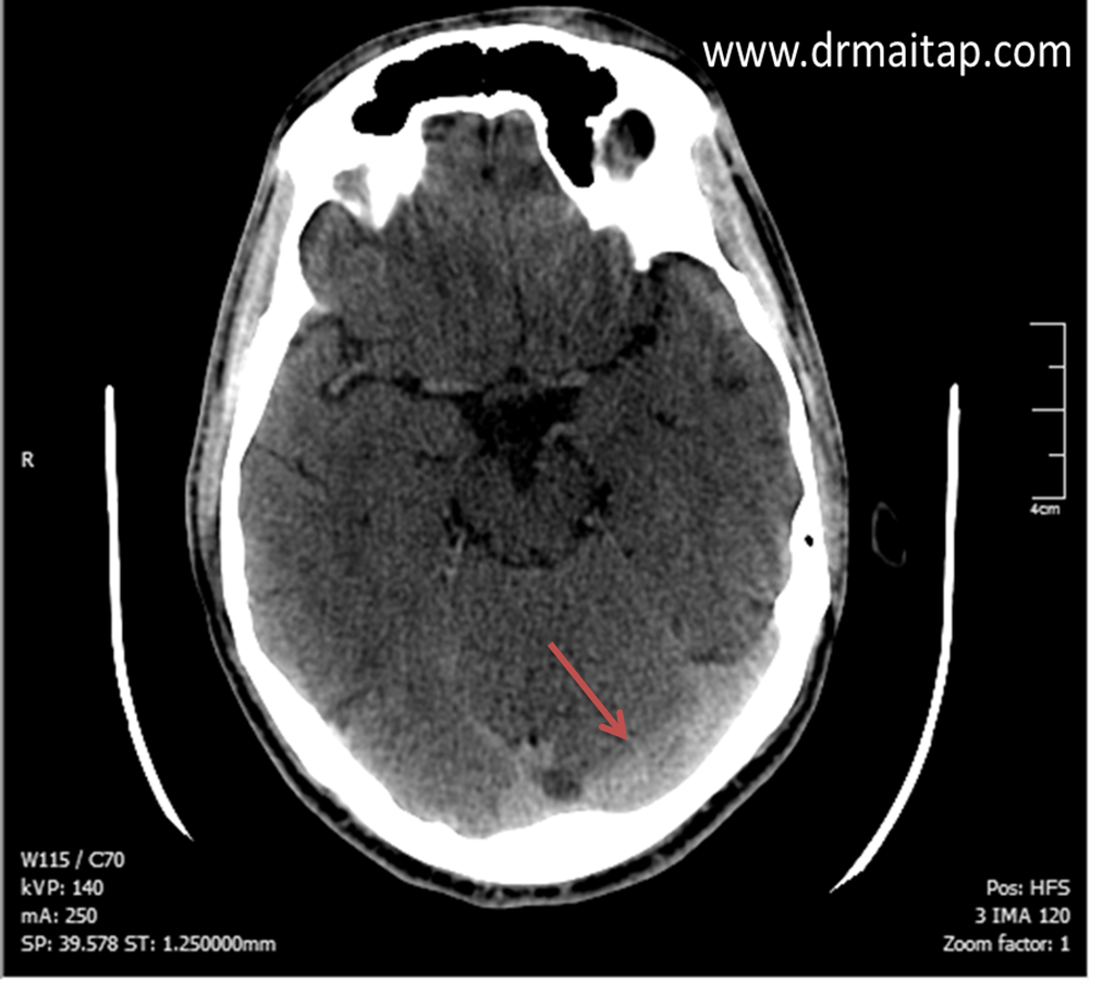 hemorragia subaracnoidea occipital
