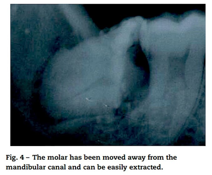 PDF: Forced extrusion for removal of impacted third molars close to the mandibular canal