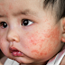 3 mẹo dân gian trị bệnh chàm ở trẻ sơ sinh