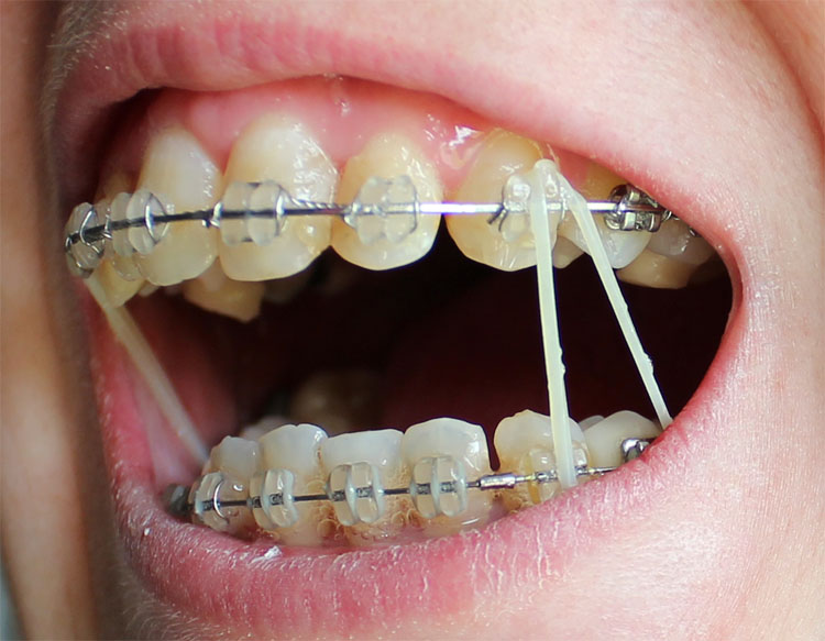 Orthodontie adulte bouche en chantier 15 mois postopératoire, 13 mois de bagues et 4