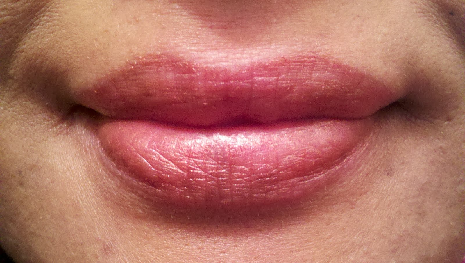 Lip Eczema/Dermatitis - Need help badly! at Peeling Lips ...