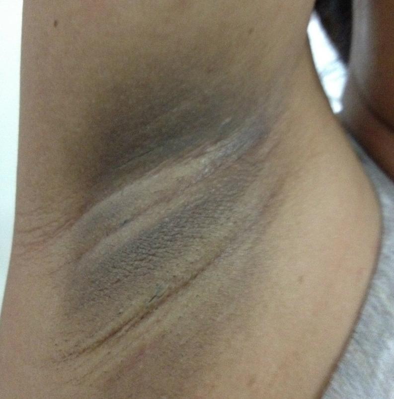 Natural Remedies For Scars On Arms Natural Remedies For Scars On Arms