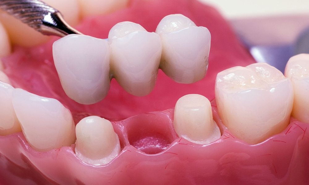 Dental Prostheses