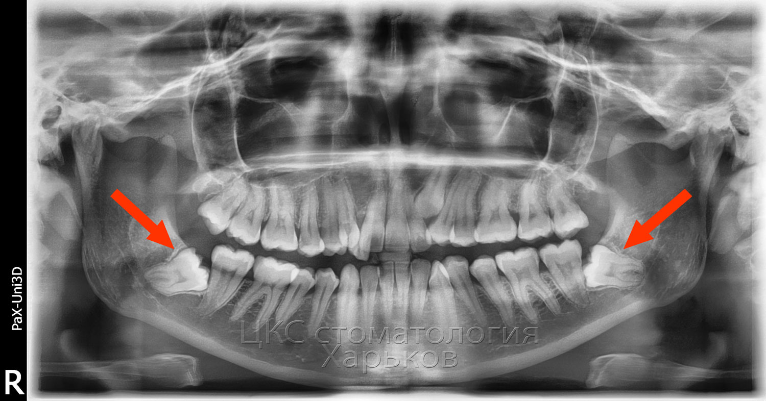 О стоматологии и не только...: Подготовка к установке брекетов (брекет ...