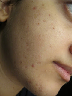 Como Quitar Las Marcas de Acne Como Quitar Las Marcas de Acne