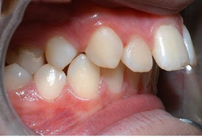 Niềng răng hô hàm trên bằng phương pháp gì