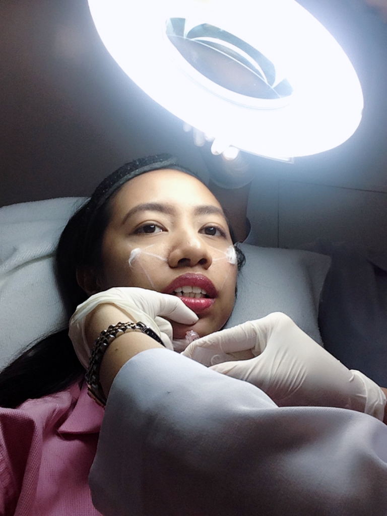dermal fillers, Galderma Philippines, Restylane, restylane cost, restylane reviews, dermal filler chin before and after