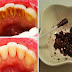 Remedios naturales para extraer la placa, el sarro, blanquear los dientes, y prevenir el mal aliento con sólo un ingrediente?