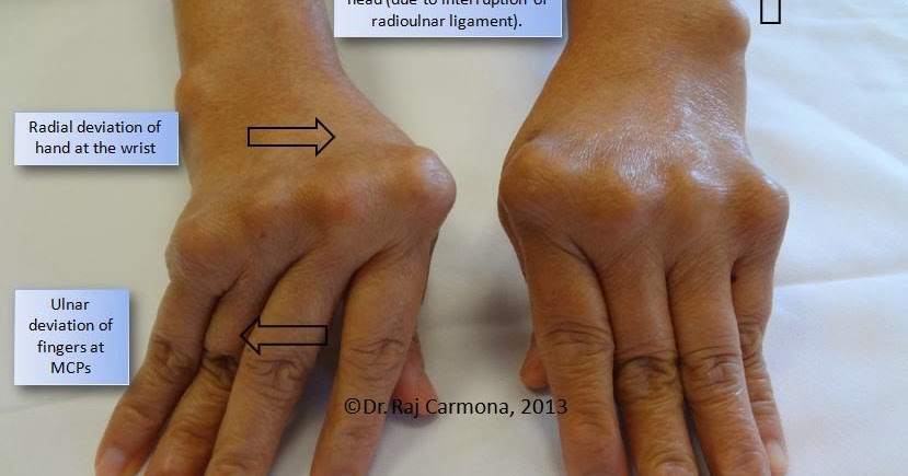 rheumatoid arthritis a kezekben