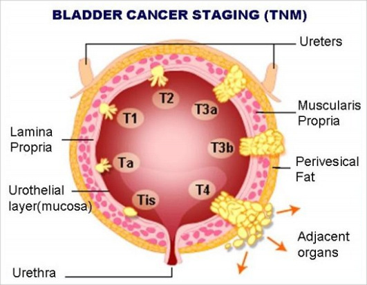 TNM Stages Of Bladder Cancer