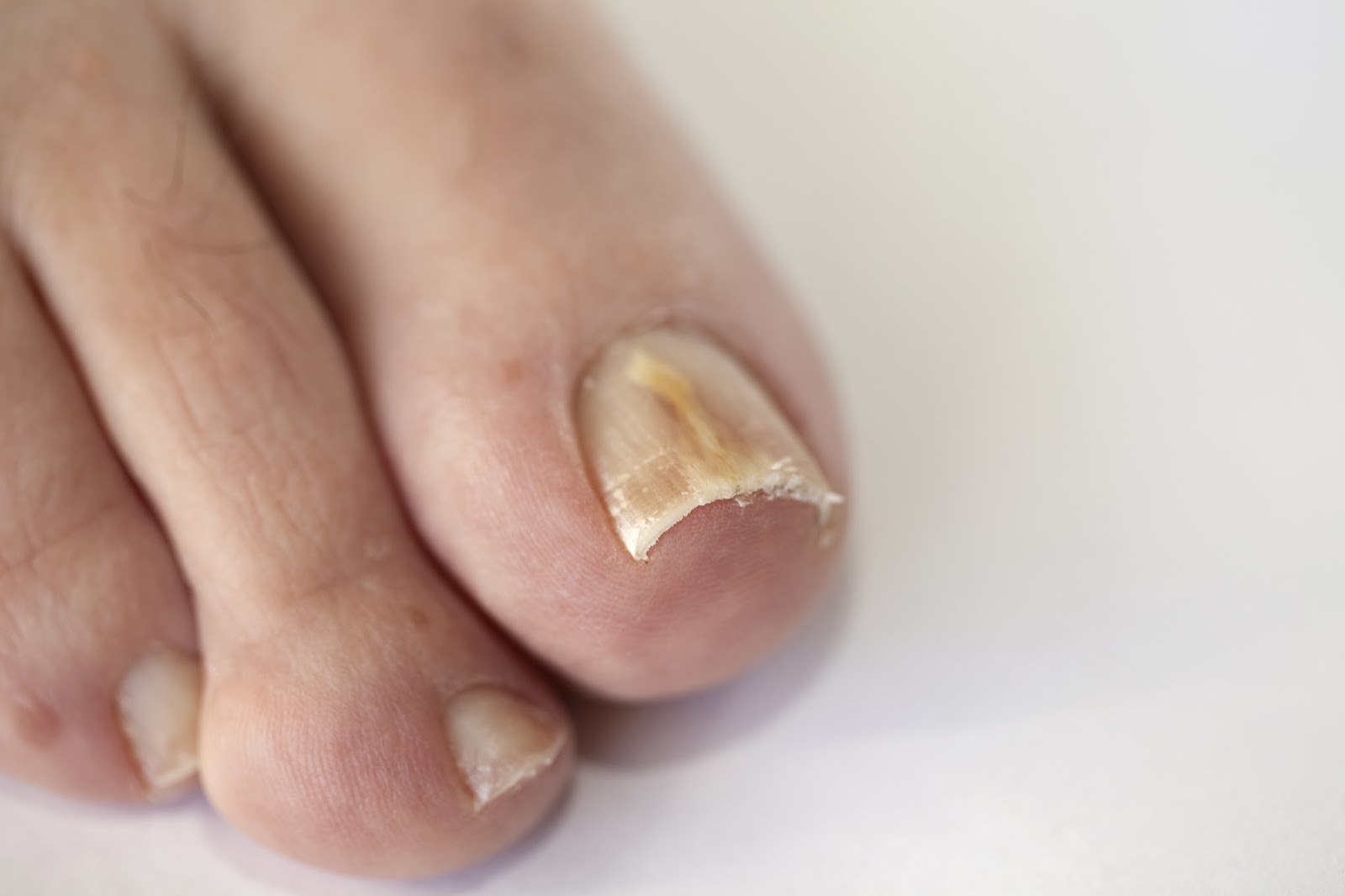 Treating your Fungal Nail Infection Best Homeopathic Medicines