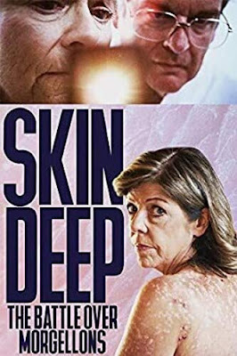 Skin Deep The Battle Over Morgellons Dvd