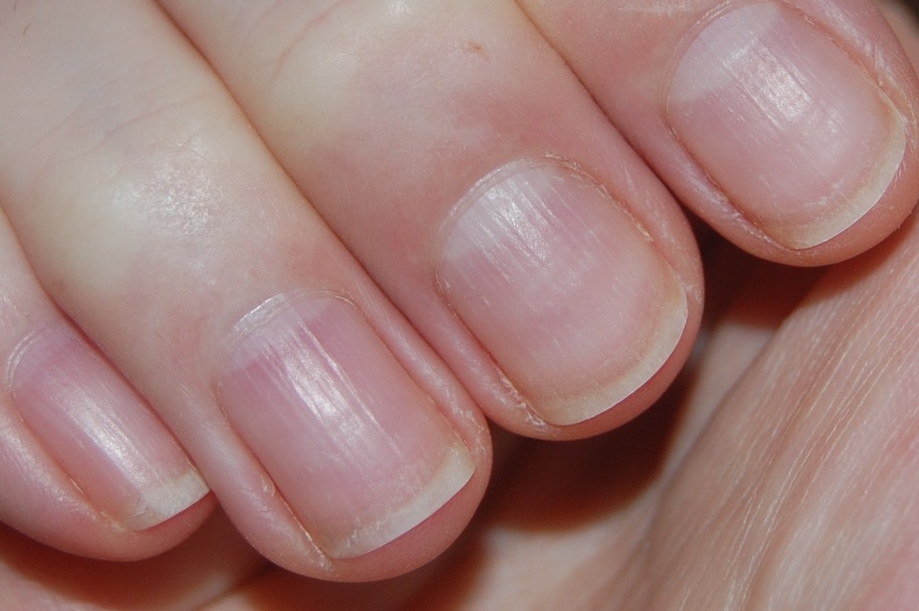 Common Nail Problems: Conditions, Treatments, and Pictures ...