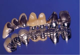 Conception des bridges dentaires en fonction de la pontique,La pontique est l’élément prothétique artificiel du bridge dentaire qui remplace la (les) dent (s) absente (s). C’est la raison d’être du bridge dentaire sur les plans fonctionnel, occlusal et esthétique,Impératifs occlusaux,Contact crestal,État de surface de l’intrados,Ancrage dentaire collé, bridge dentaire, bridge dentaire prix, Bridge dento-implanto-porté, types de bridges dentaires,