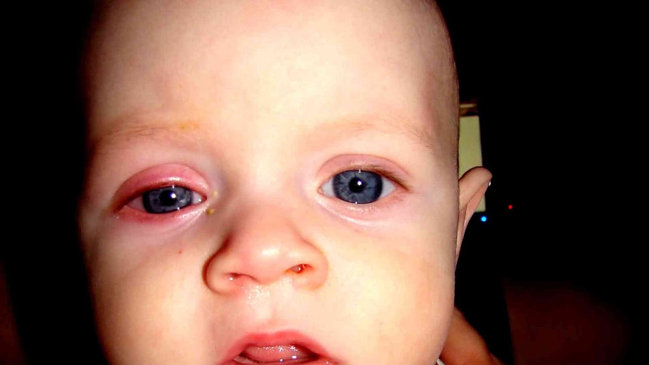 Pink Eye In Infants Pictures Pink Choices
