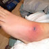 How To Cure MRSA Infection Naturally Fast At Home