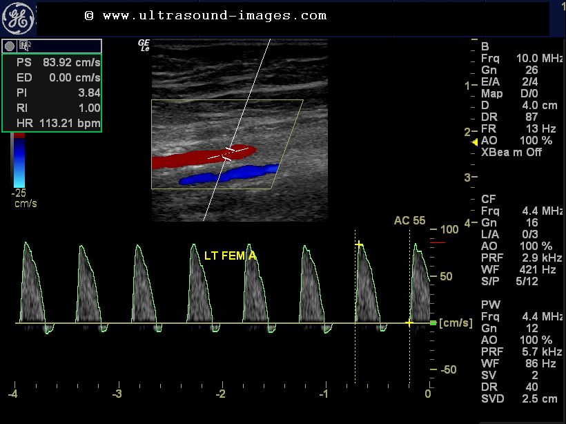 Ultrasound imaging: Color Doppler study of severe arterial..