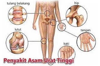 Obat asam urat kumis kucing, asam urat gak sembuh sembuh, asam urat dibawah normal, asam urat obat nya apa, obat asam urat paling ampuh apotik, asam urat normal pada laki laki, pengobatan asam urat yang alami, asam urat aplikasi, asam urat makan kacang almond, kenapa asam urat gak boleh dipijat, gejala penyakit asam urat dan pantangannya