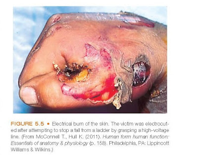 Electrical burn of the skin. The victim was electrocuted after attempting to stop a fall from a ladder by grasping a high-voltage line.