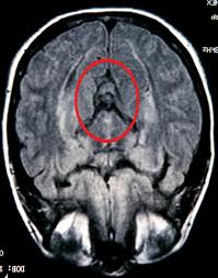 mri scan images of brain tumor Photos real pictures