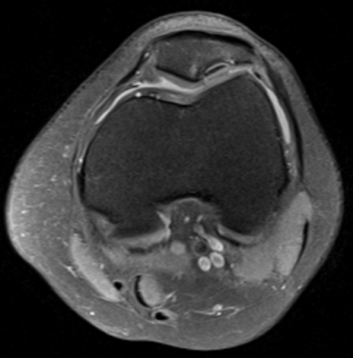 Stable patellar osteochondral fracture