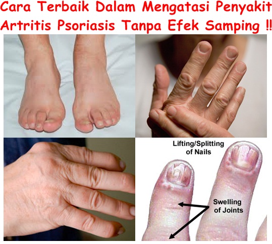 Obat Tradisional Artritis Psoriasis