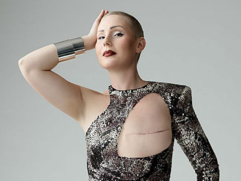 женщина после удаления молочной железы. топ после мастэктомии. женщина после удаления молочной железы. женщины с удаленной грудью. женская грудь после мастэктомии.