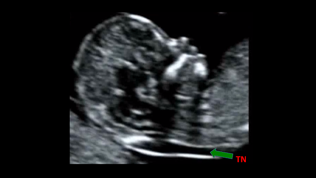 Ultrassonografia, primeiro trimestre, translucência nucal, TN, Nasceu uma Mãe, gravidez, sexo do bebê, é menino, é menina, Mamãe Gatona, síndrome de down, doença cardíacas