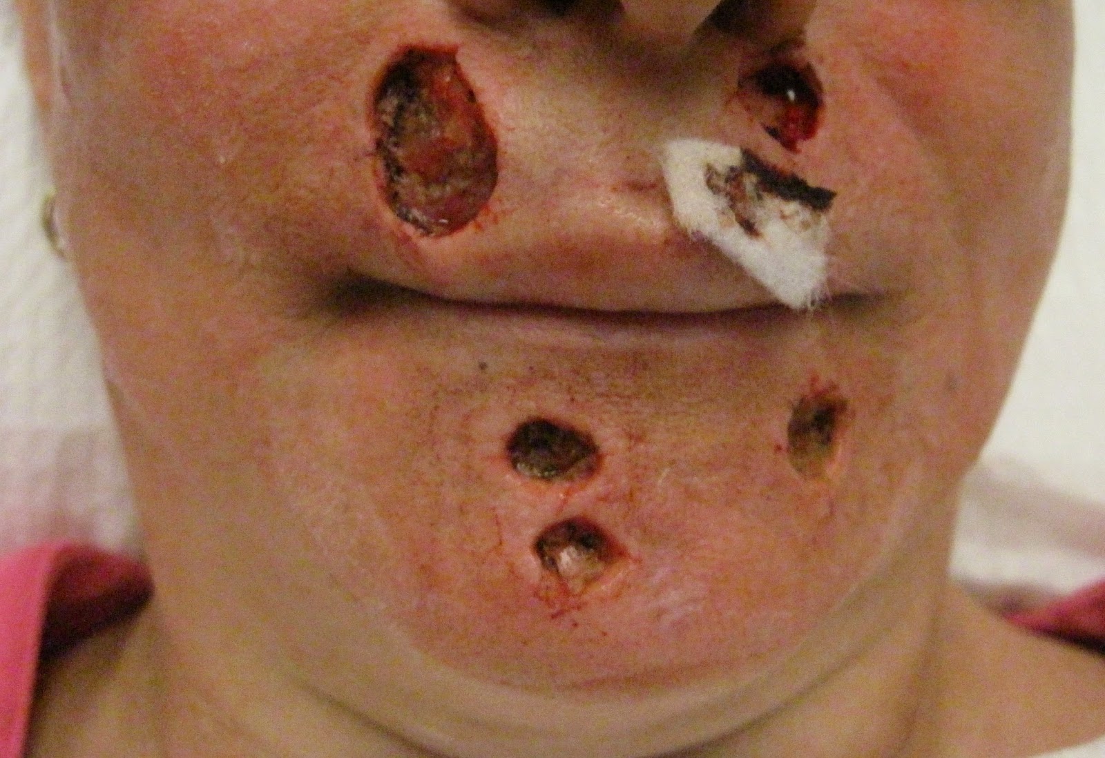 Basal Cell Nevus Syndrome-My Journey: Mile 20 with Basal Cell Nevus