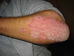 Cara Alami Menyembuhkan Psoriasis Vulgaris Cara Alami Menyembuhkan Psoriasis Vulgaris