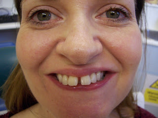 Sam before Invisalign treatment at Appledore Dental Clinic Milton Keynes