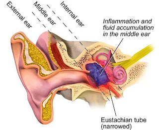 Otitis Media